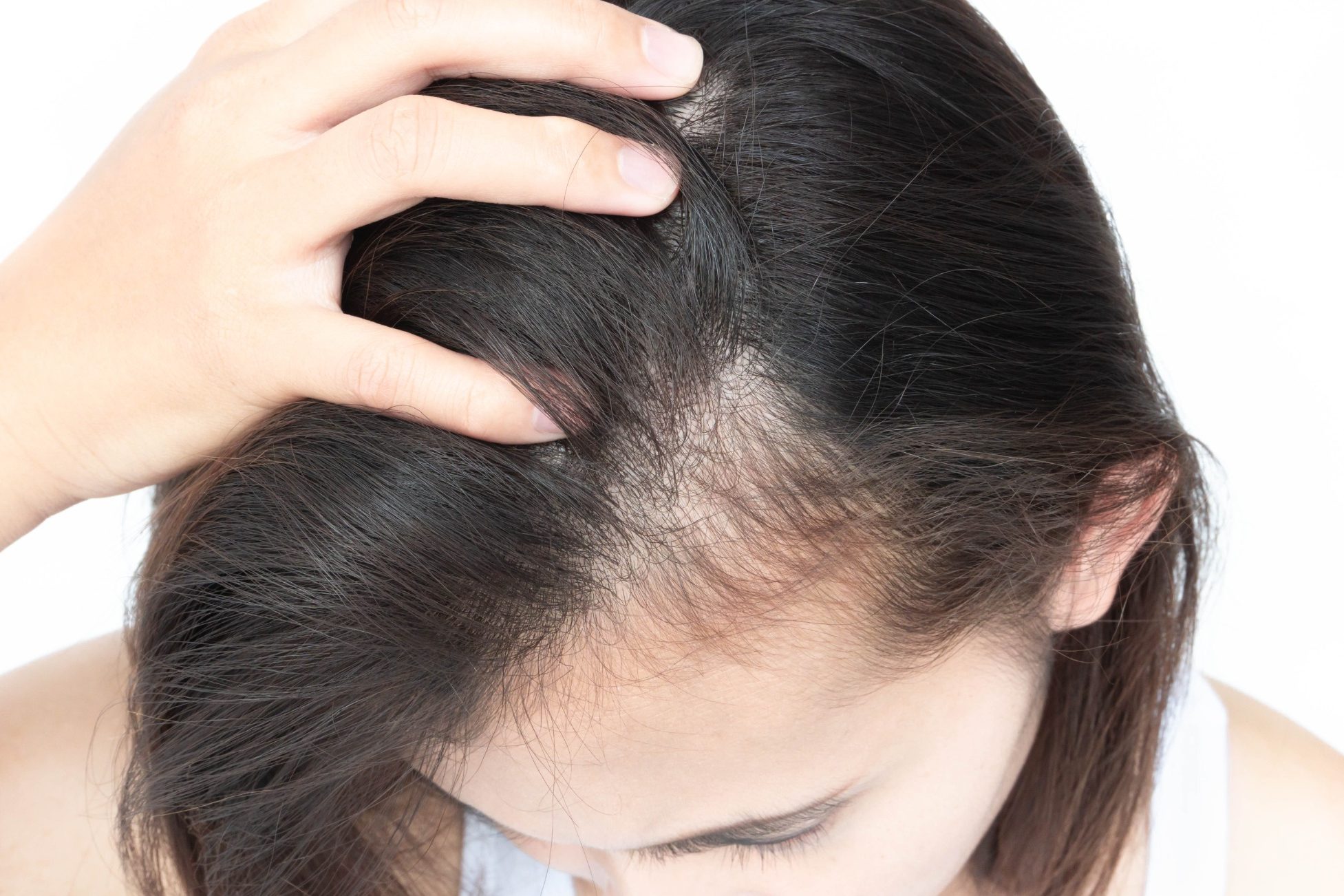 Haarausfall bei einer Frau Haarausfall bei einer Frau